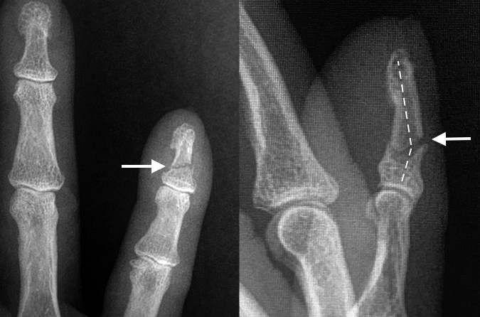 FINGER DISTAL PHALANX FRACTURES Hand Surgery Resource   Ps Fx AP   Lat Initial1 0 0 